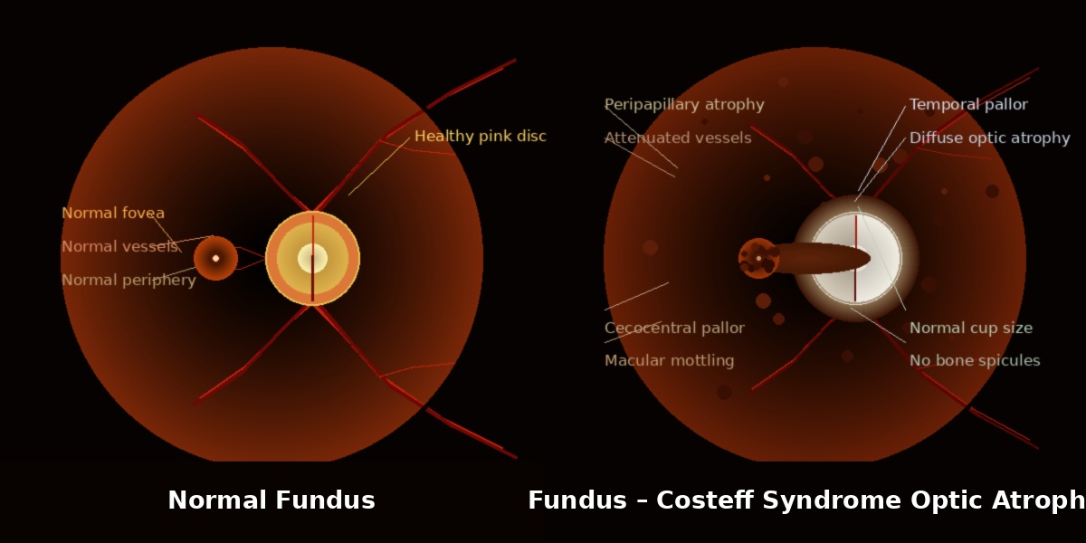 Normal fundus versus Costeff Syndrome optic atrophy fundus illustration