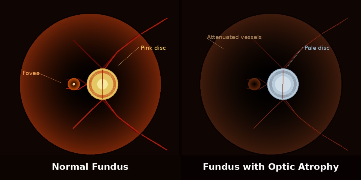 Normal fundus versus optic atrophy fundus illustration
