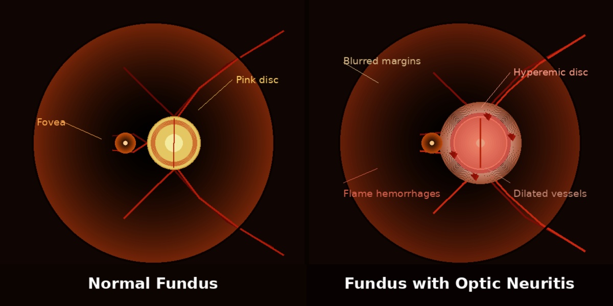 "Eye diagram showing healthy optic disc and inflamed disc with blurred margins