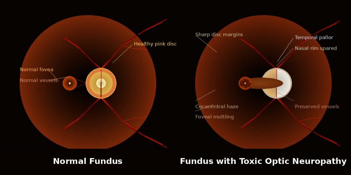 "Normal fundus versus toxic optic neuropathy fundus illustration