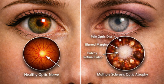 Eye diagram showing healthy optic disc and pathological changes in multiple sclerosis optic neuropath