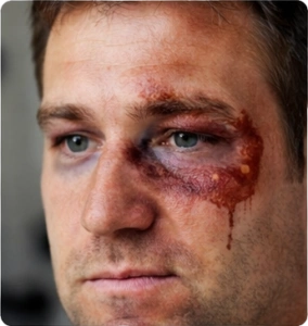 Medical illustration of blunt force injury near eye