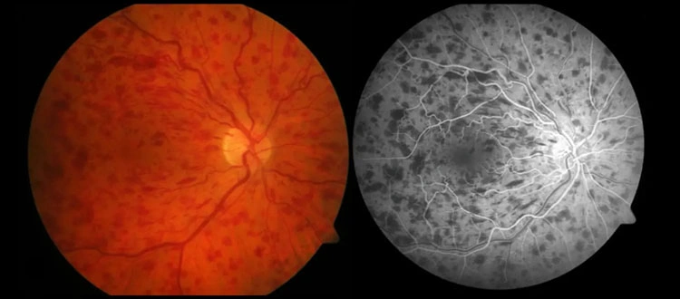 eye disorder