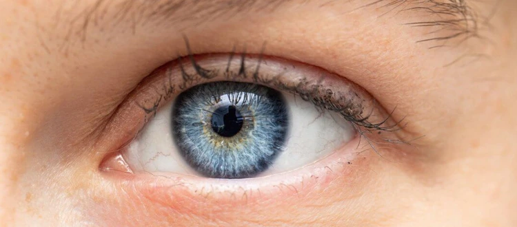 optic atrophy