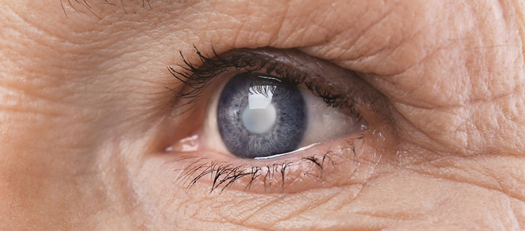Human eye with cloudy lens due to cataract