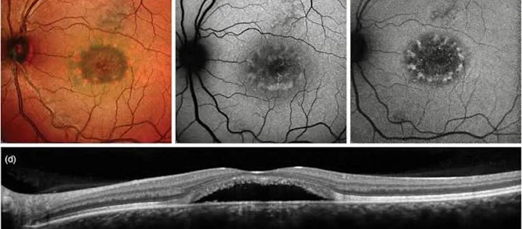 optic nerve